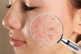 دلایل ایجاد جوش پس از لیزر