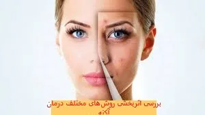 بررسی اثربخشی روش‌های مختلف درمان آکنه
